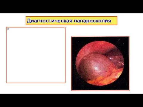 Диагностическая лапароскопия