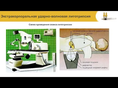 Экстракорпоральная ударно-волновая литотрипсия Схема проведения сеанса литотрипсии