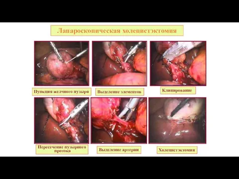Лапароскопическая холецистэктомия Пункция желчного пузыря Выделение элементов Клипирование Пересечение пузырного протока Выделение артерии Холецистэктомия