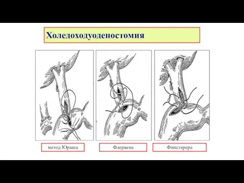 Холедоходуоденостомия метод Юраша Флеркена Финстерера