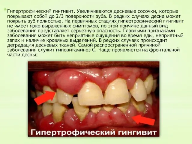 Гипертрофический гингивит. Увеличиваются десневые сосочки, которые покрывают собой до 2/3