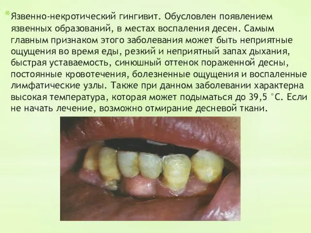 Язвенно-некротический гингивит. Обусловлен появлением язвенных образований, в местах воспаления десен.