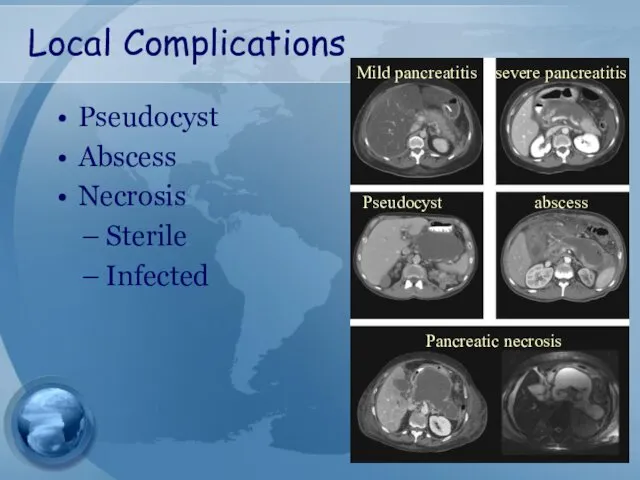 Local Complications Pseudocyst Abscess Necrosis Sterile Infected Mild pancreatitis severe pancreatitis Pseudocyst abscess Pancreatic necrosis