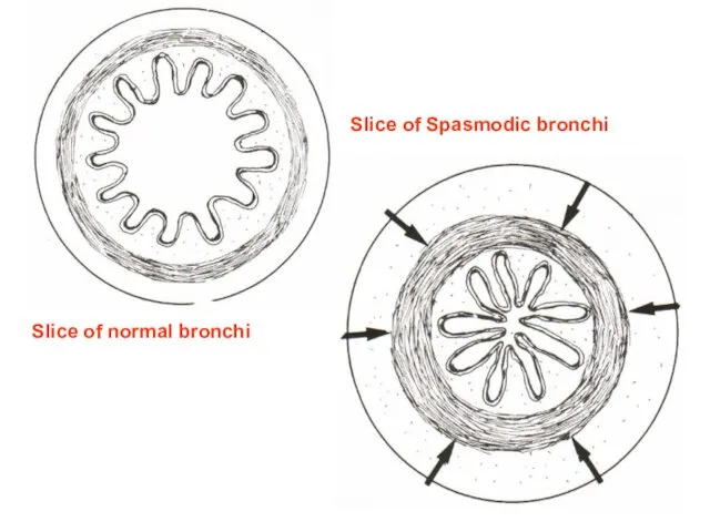 Slice of normal bronchi Slice of Spasmodic bronchi