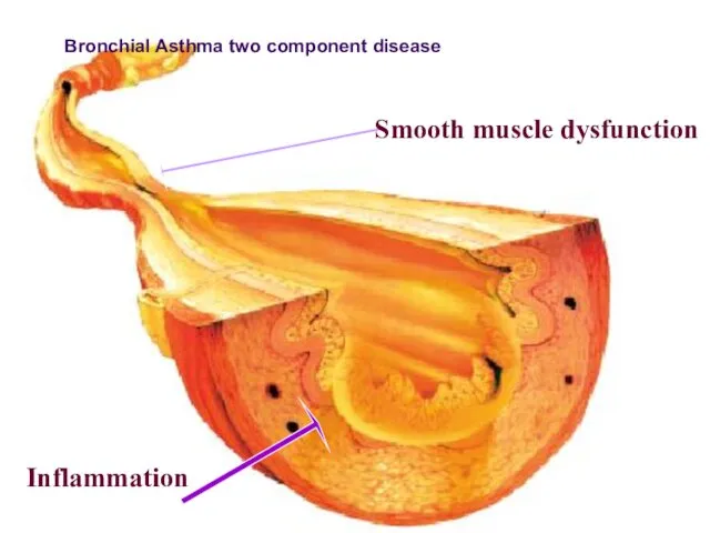 Smooth muscle dysfunction Inflammation ПАТОГЕНЕЗ БРОНХИАЛЬНОЙ АСТМЫ Bronchial Asthma two component disease