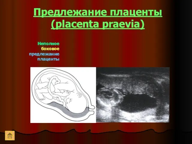 Предлежание плаценты (placenta praevia) Неполное боковое предлежание плаценты