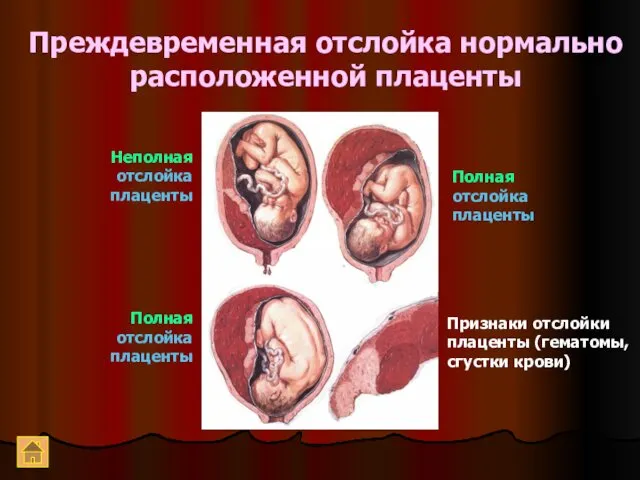 Преждевременная отслойка нормально расположенной плаценты Неполная отслойка плаценты Полная отслойка