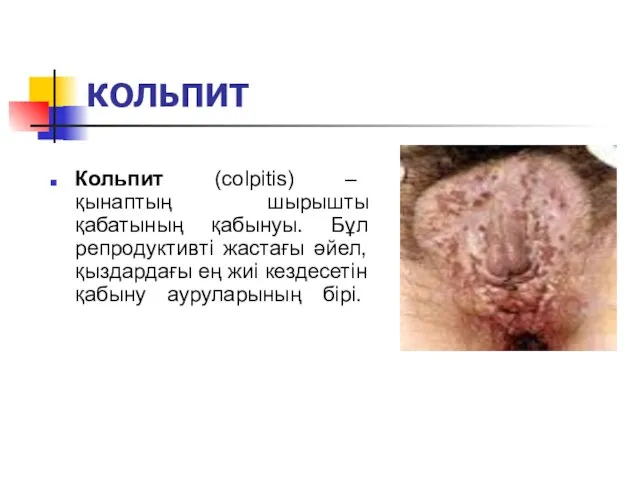 КОЛЬПИТ Кольпит (colpitis) – қынаптың шырышты қабатының қабынуы. Бұл репродуктивті