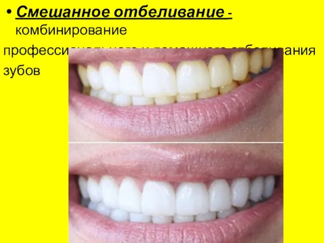 Смешанное отбеливание - комбинирование профессионального и домашнего отбеливания зубов