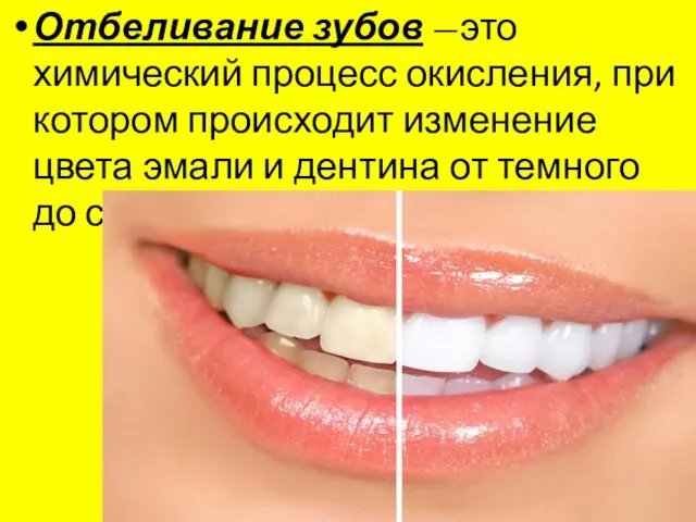Отбеливание зубов —это химический процесс окисления, при котором происходит изменение цвета эмали и