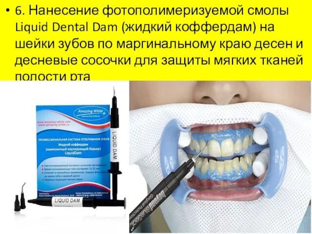 6. Нанесение фотополимеризуемой смолы Liquid Dental Dam (жидкий коффердам) на шейки зубов по