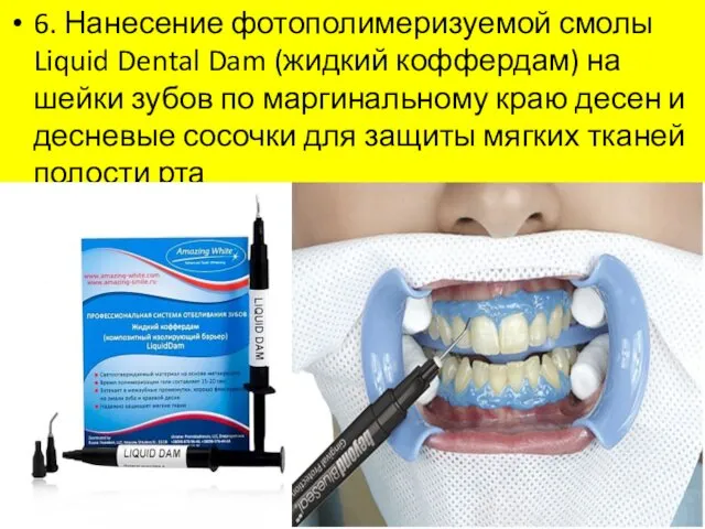 6. Нанесение фотополимеризуемой смолы Liquid Dental Dam (жидкий коффердам) на