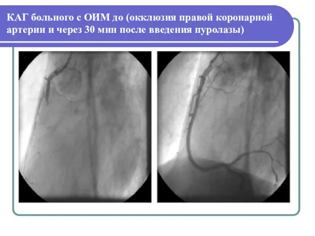 КАГ больного с ОИМ до (окклюзия правой коронарной артерии и через 30 мин после введения пуролазы)