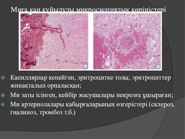 Миға қан құйылуды микроскопиялық көріністері Капиллярлар кеңейген, эритроцитке толы, эритроциттер