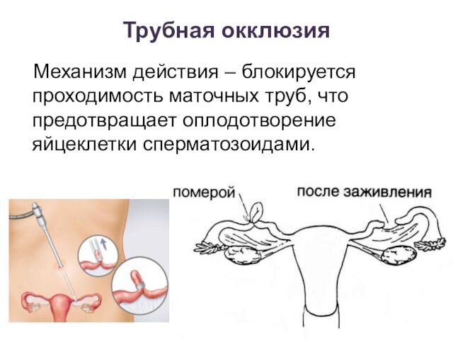 Трубная окклюзия Механизм действия – блокируется проходимость маточных труб, что предотвращает оплодотворение яйцеклетки сперматозоидами.