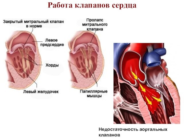 Работа клапанов сердца Недостаточность аортальных клапанов