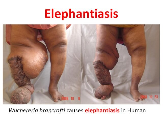ElephantiasisWuchereria brancrofti causes elephantiasis in Human