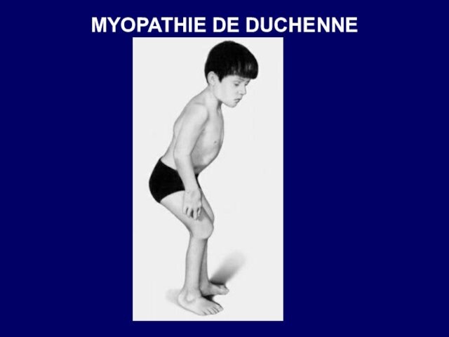 MYOPATHIE DE DUCHENNE