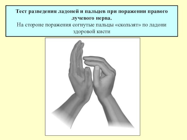 На стороне поражения согнутые пальцы «скользят» по ладони здоровой кисти