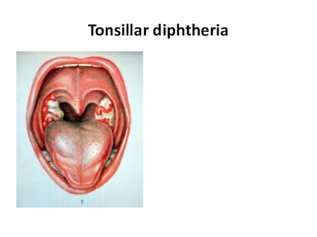 Tonsillar diphtheria