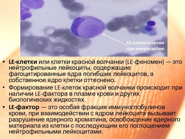 LE-клетки или клетки красной волчанки (LE-феномен) — это нейтрофильные лейкоциты, содержащие фагоцитированные ядра погибших лейкоцитов,