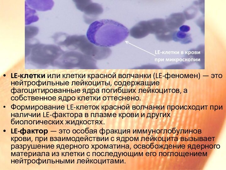 LE-клетки или клетки красной волчанки (LE-феномен) — это нейтрофильные лейкоциты, содержащие фагоцитированные ядра погибших лейкоцитов, а собственное ядро