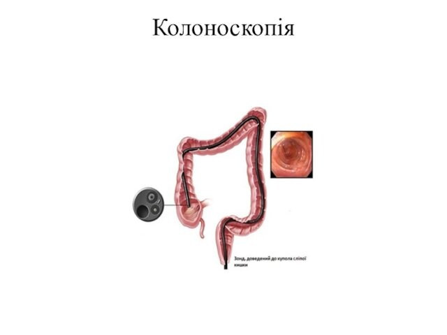 Колоноскопія