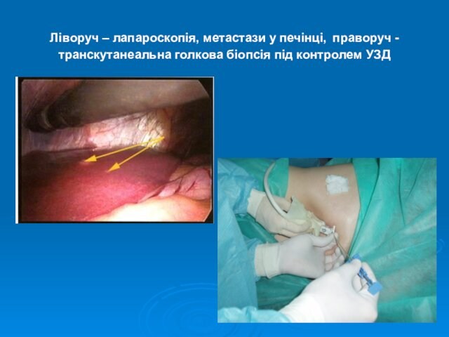 Ліворуч – лапароскопія, метастази у печінці, праворуч - транскутанеальна голкова біопсія під контролем УЗД