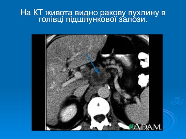 На КТ живота видно ракову пухлину в голівці підшлункової залози.
