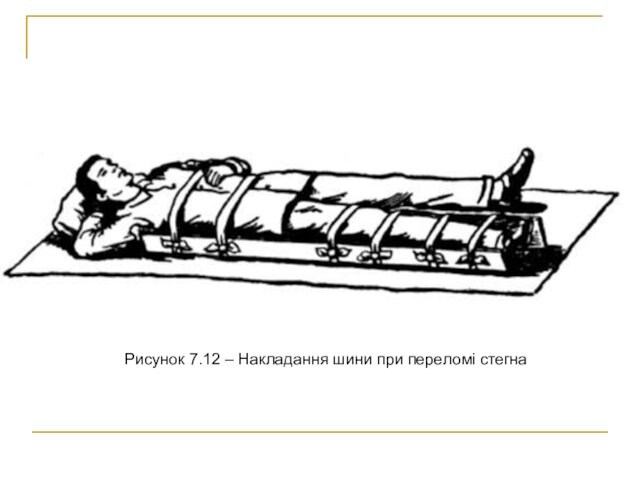 Рисунок 7.12 – Накладання шини при переломі стегна