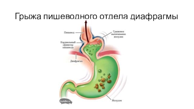 Грыжа пищеводного отдела диафрагмы