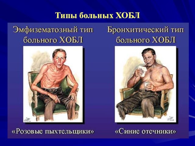 Типы больных ХОБЛ (З.Р. Айсанов, А.Н. Кокосов,2001)
