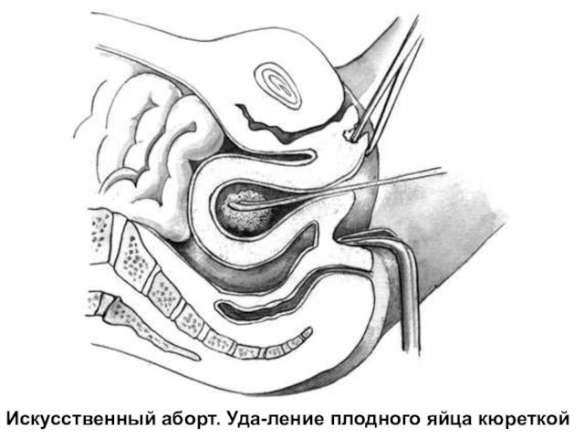 Искусственный аборт. Уда-ление плодного яйца кюреткой
