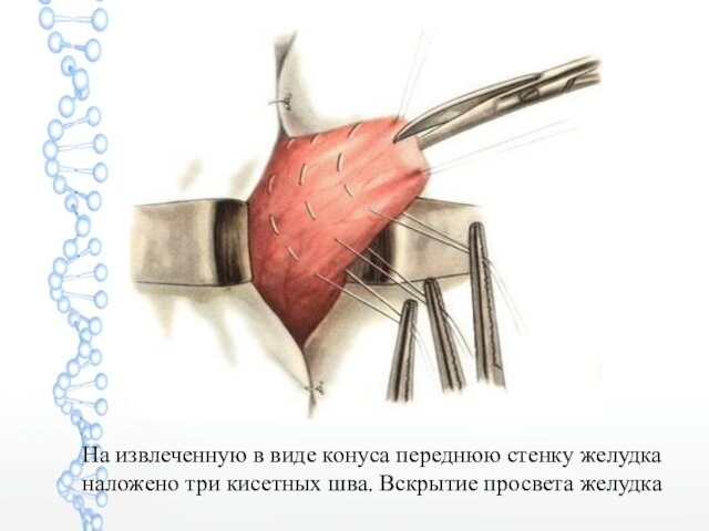 На извлеченную в виде конуса переднюю стенку желудка наложено три кисетных шва. Вскрытие просвета желудка