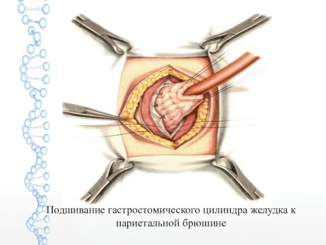 Подшивание гастростомического цилиндра желудка к париетальной брюшине