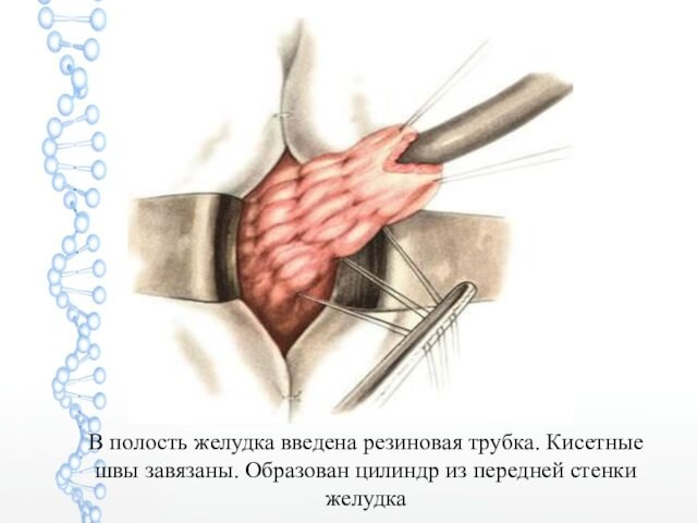 В полость желудка введена резиновая трубка. Кисетные швы завязаны. Образован цилиндр из передней стенки желудка
