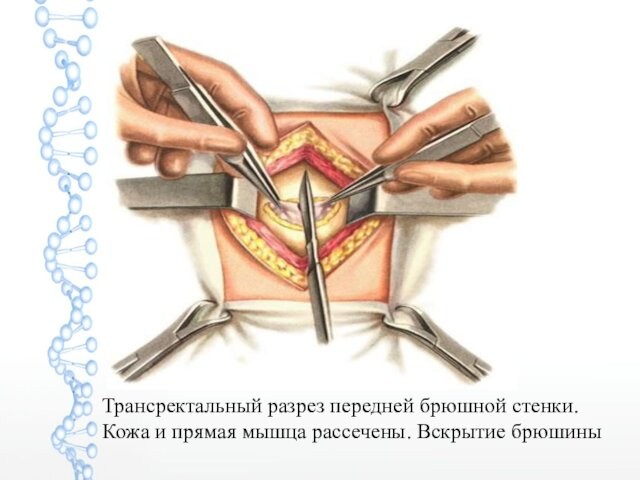 Трансректальный разрез передней брюшной стенки.  Кожа и прямая мышца рассечены. Вскрытие брюшины