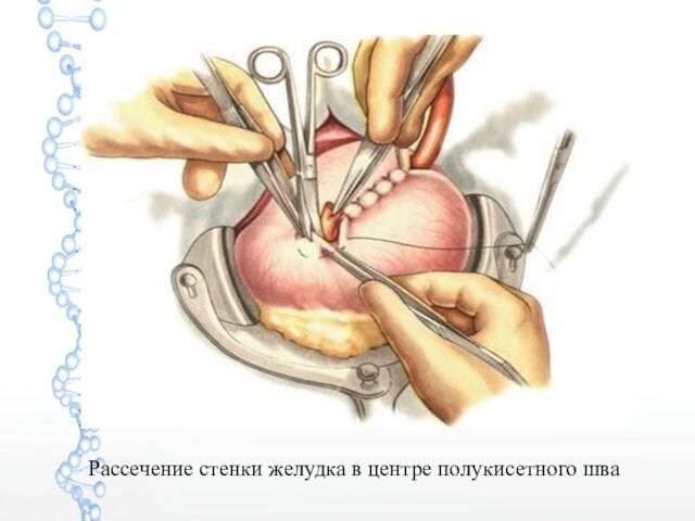 Рассечение стенки желудка в центре полукисетного шва