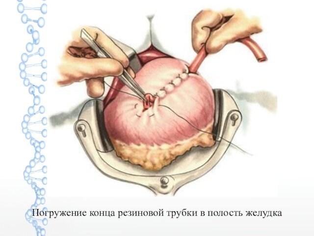 Погружение конца резиновой трубки в полость желудка