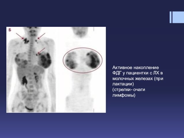 Активное накопление ФДГ у пациентки с ЛХ в молочных железах (при лактации)(стрелки- очаги лимфомы)