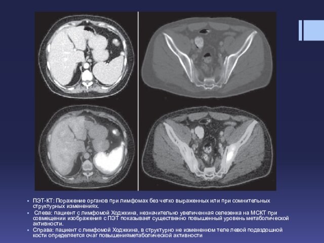 ПЭТ-КТ: Поражение органов при лимфомах без четко выраженных или при сомнительных структурных изменениях. Слева: пациент