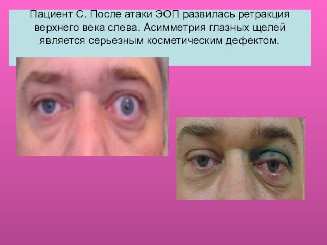 Пациент С. После атаки ЭОП развилась ретракция верхнего века слева. Асимметрия глазных щелей является серьезным