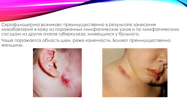 Скрофулодерма возникает преимущественно в результате занесения микобактерий в кожу из пораженных лимфатических узлов и по