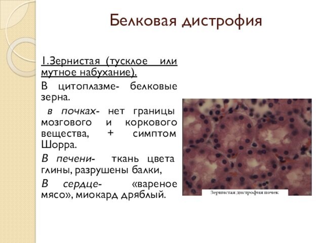 Белковая дистрофия 1.Зернистая (тусклое или мутное набухание). В цитоплазме- белковые зерна. в почках- нет