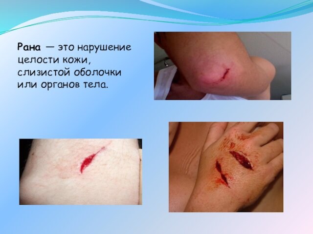 Рана — это нарушение целости кожи, слизистой оболочки или органов тела.
