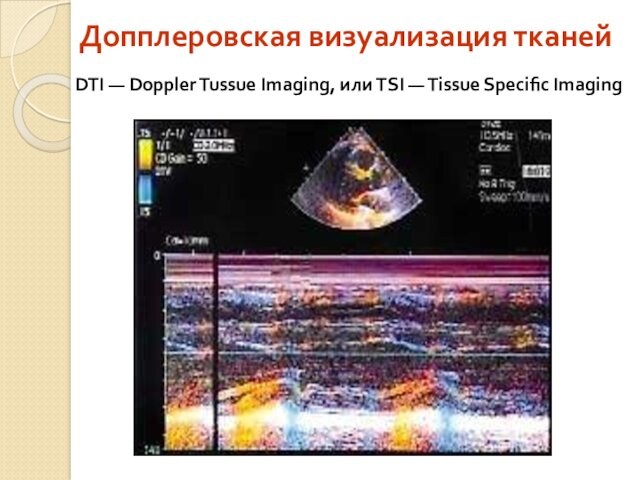 Допплеровская визуализация тканей DTI — Doppler Tussue Imaging, или TSI — Tissue Specific Imaging