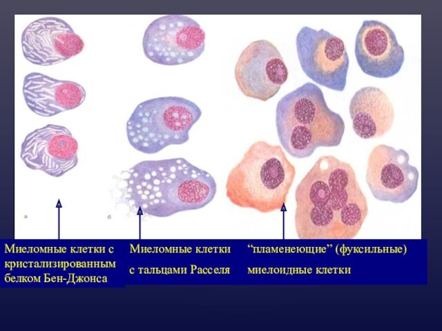 Миеломные клетки с кристализированным белком Бен-ДжонсаМиеломные клетки с тальцами Расселя“пламенеющие” (фуксильные) миелоидные клетки