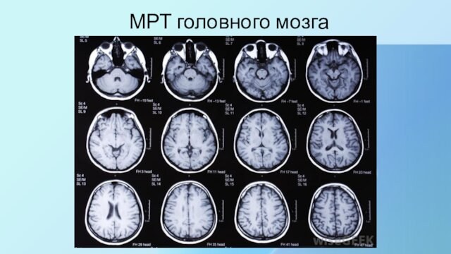 МРТ головного мозга