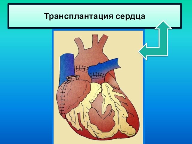 Трансплантация сердца