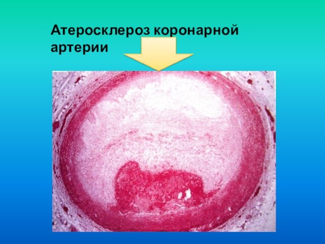 Атеросклероз коронарной артерии